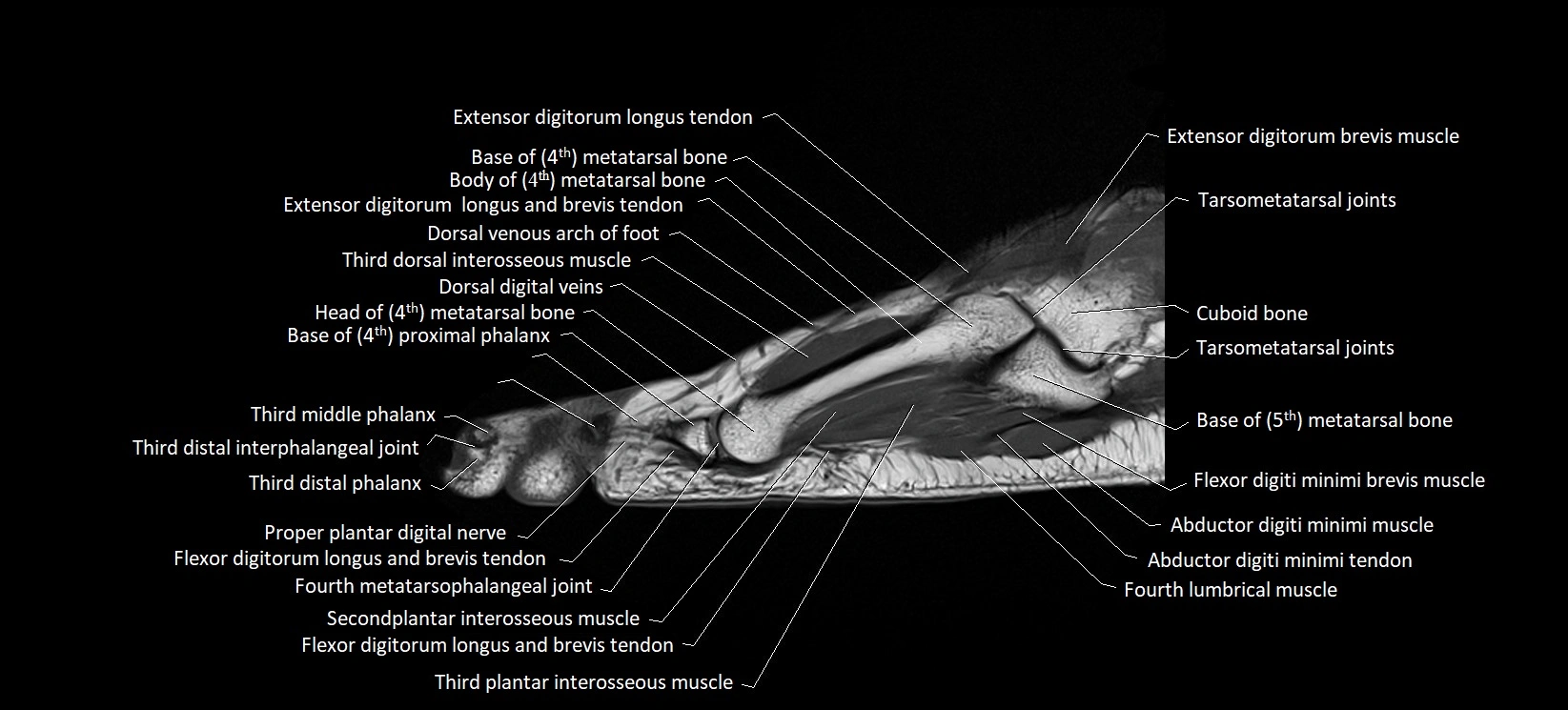 MRI foot sagittal labelled cross sectional anatomy image  19.webp